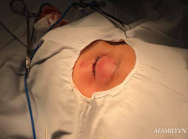 Tai nạn kinh hoàng: Đi đổi bình gas mini cho mẹ, bé trai 9 tuổi bị tay lái xe đạp đập lòi mắt trái - Ảnh 4.